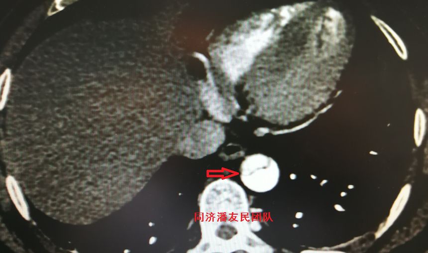 诊断主动脉夹层最简单有效的方法,心脏主动脉夹层是什么原因造成的