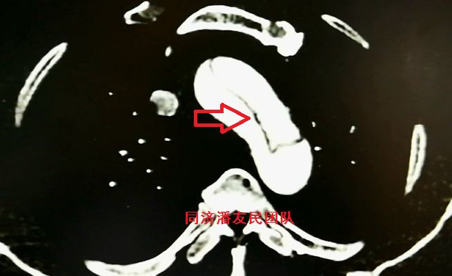 诊断主动脉夹层最简单有效的方法,心脏主动脉夹层是什么原因造成的