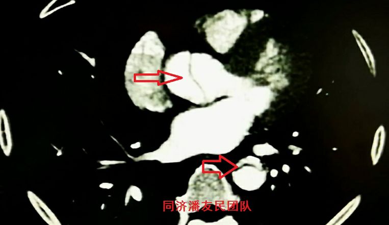 诊断主动脉夹层最简单有效的方法,心脏主动脉夹层是什么原因造成的