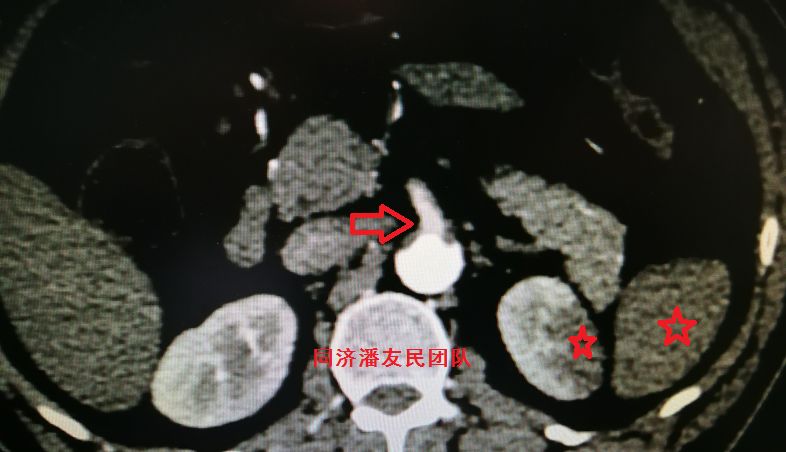 诊断主动脉夹层最简单有效的方法,心脏主动脉夹层是什么原因造成的