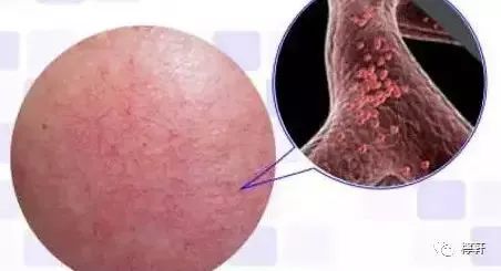 孕期皮肤出现血丝,皮肤红血丝怎么治