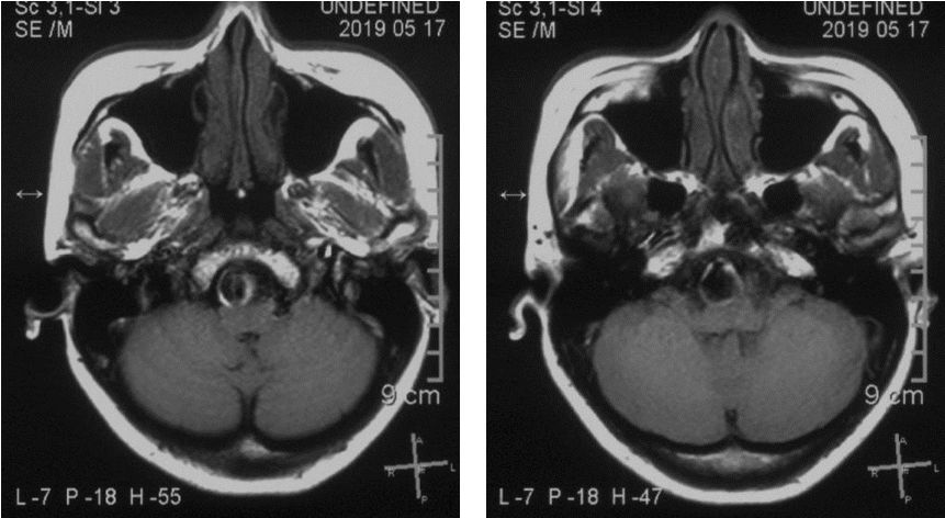 椎动脉夹层动脉瘤的最佳治疗方法,椎基底动脉夹层动脉瘤治疗方法