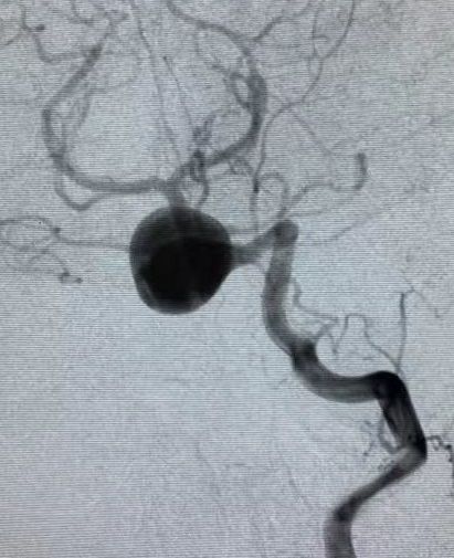 椎动脉夹层动脉瘤的最佳治疗方法,椎基底动脉夹层动脉瘤治疗方法