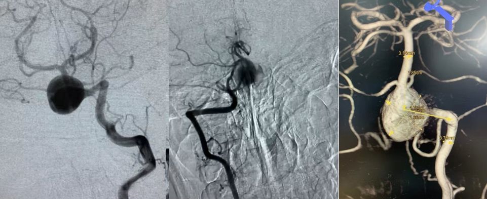 椎动脉夹层动脉瘤的最佳治疗方法,椎基底动脉夹层动脉瘤治疗方法