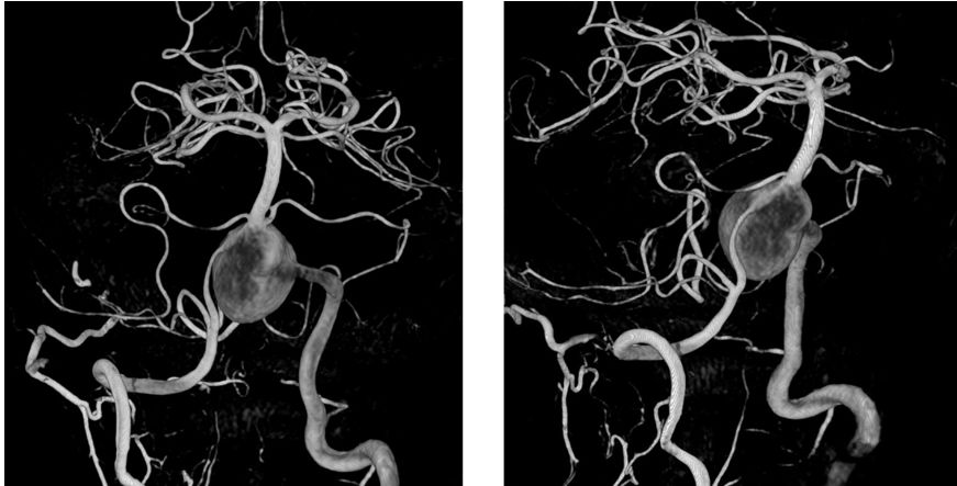 椎动脉夹层动脉瘤的最佳治疗方法,椎基底动脉夹层动脉瘤治疗方法