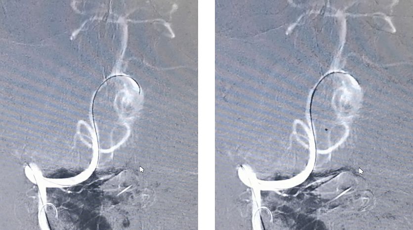 椎动脉夹层动脉瘤的最佳治疗方法,椎基底动脉夹层动脉瘤治疗方法