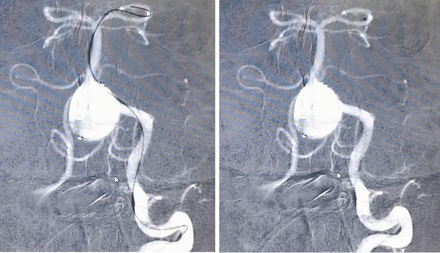 椎动脉夹层动脉瘤的最佳治疗方法,椎基底动脉夹层动脉瘤治疗方法