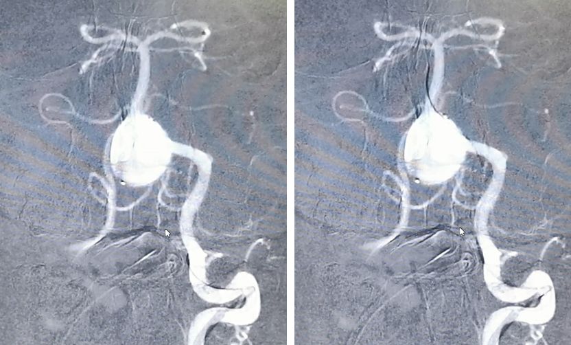 椎动脉夹层动脉瘤的最佳治疗方法,椎基底动脉夹层动脉瘤治疗方法