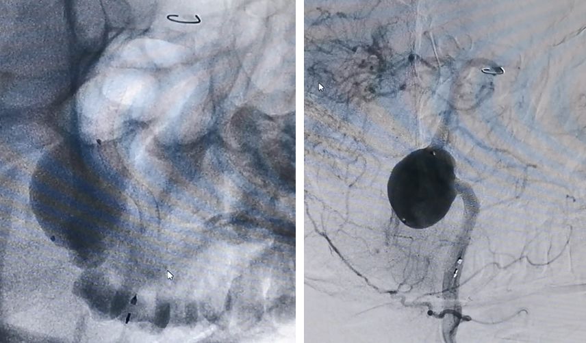 椎动脉夹层动脉瘤的最佳治疗方法,椎基底动脉夹层动脉瘤治疗方法