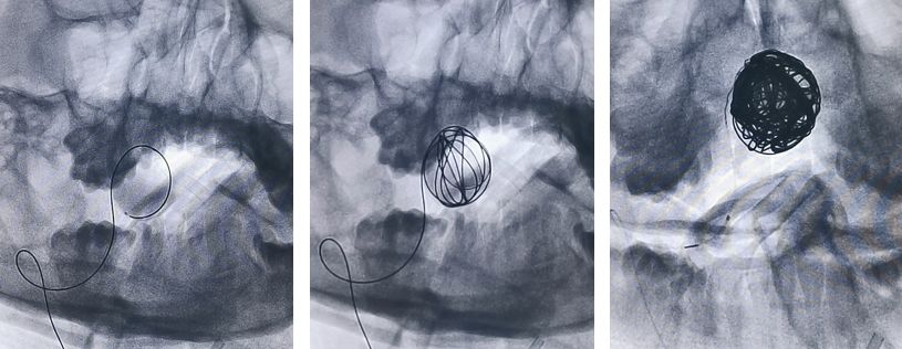 椎动脉夹层动脉瘤的最佳治疗方法,椎基底动脉夹层动脉瘤治疗方法