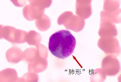 外周血细胞形态分析能查出什么病,外周血细胞形态能看出白血病吗