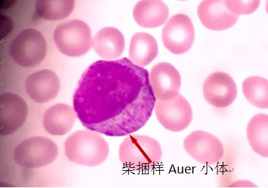 外周血细胞形态分析能查出什么病,外周血细胞形态能看出白血病吗