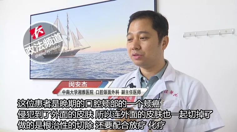 槟榔导致口腔癌前兆,小伙嚼一年槟榔后口腔患癌前病变