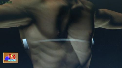 胸廓畸形矫正后会反弹吗,胸廓畸形矫正术后恢复