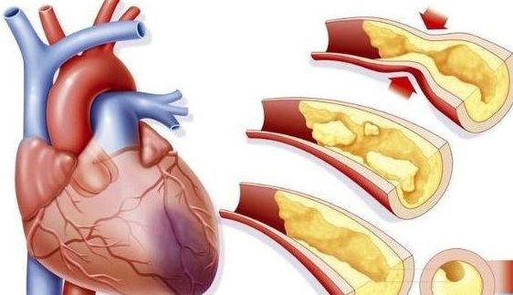 突发心肌梗死错过了最佳十二小时,年轻人心肌梗塞为什么更严重