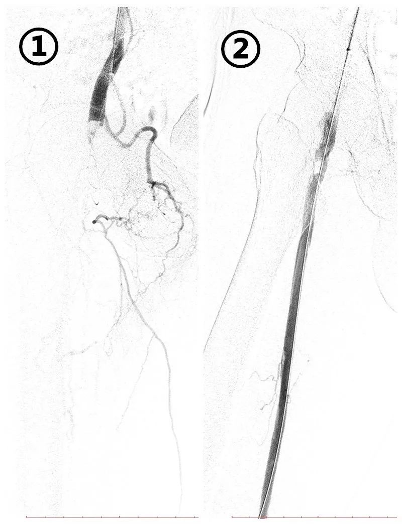 截肢一条腿怎么做康复,截肢掉的腿一般都怎么处理
