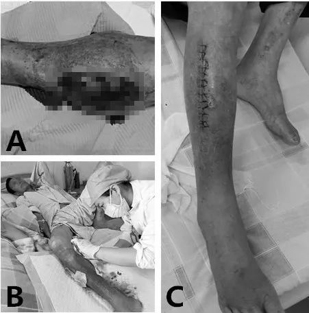 截肢一条腿怎么做康复,截肢掉的腿一般都怎么处理