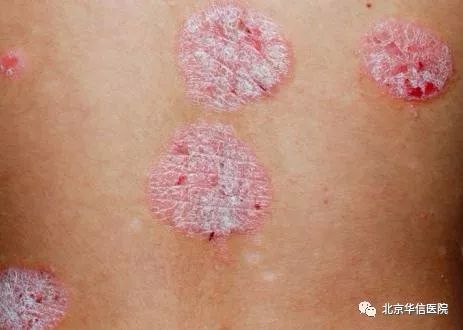 皮肤出现瘙痒是身体有问题吗,皮肤瘙痒可能会预示哪种疾病