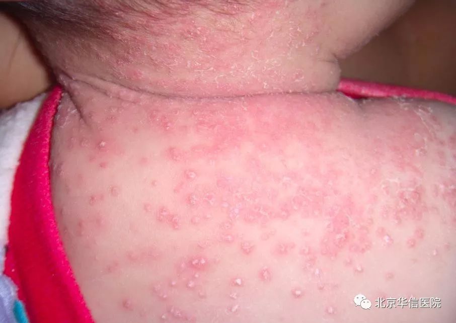 皮肤出现瘙痒是身体有问题吗,皮肤瘙痒可能会预示哪种疾病