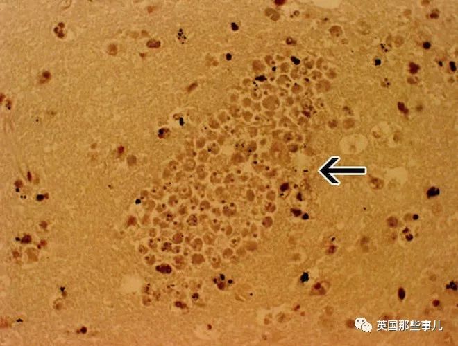 大爷感染食脑虫后一命呜呼，居然是因为游泳时呛了一口水