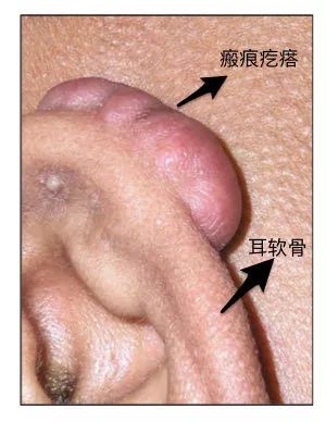 打耳洞容易出事情吗,打耳洞可能会聋吗