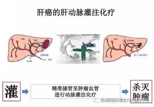 大咯血的抢救药物,支扩栓塞止血后大咯血还会复发吗