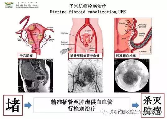 大咯血的抢救药物,支扩栓塞止血后大咯血还会复发吗