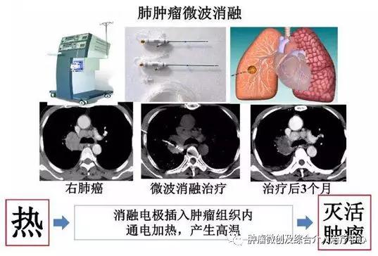 大咯血的抢救药物,支扩栓塞止血后大咯血还会复发吗