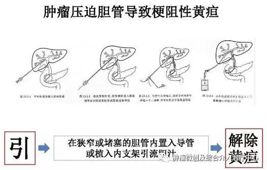 大咯血的抢救药物,支扩栓塞止血后大咯血还会复发吗