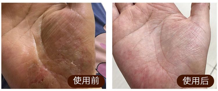 足癣湿疹用什么药膏最有效,皮炎湿疹足癣