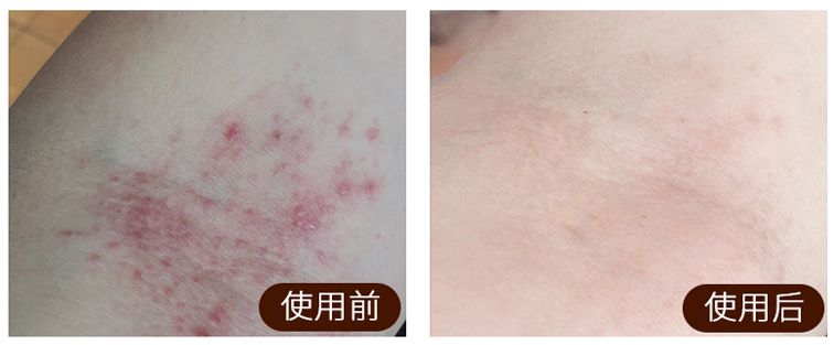 足癣湿疹用什么药膏最有效,皮炎湿疹足癣