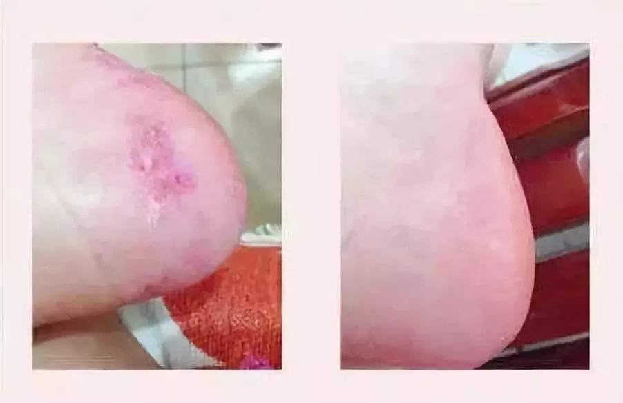 足癣湿疹用什么药膏最有效,皮炎湿疹足癣