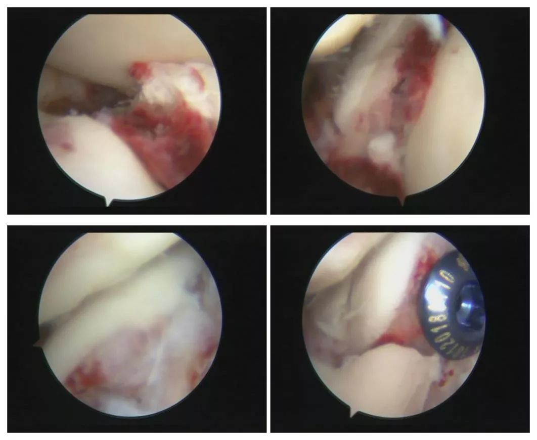 跟骨粉碎性骨折100天还不能下地走,跟骨粉碎性骨折保守治疗的视频