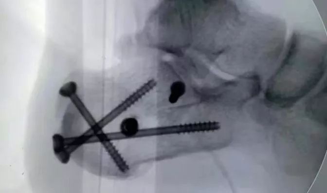 跟骨粉碎性骨折100天还不能下地走,跟骨粉碎性骨折保守治疗的视频