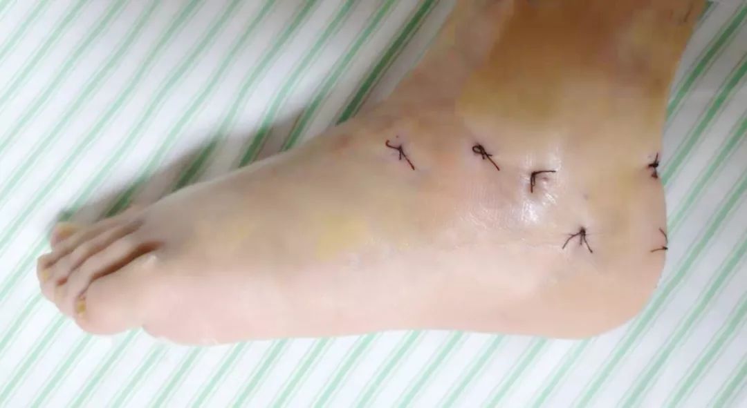 跟骨粉碎性骨折100天还不能下地走,跟骨粉碎性骨折保守治疗的视频