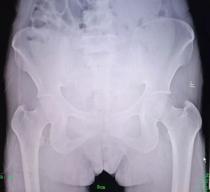 把弹簧换成气囊,自己如何取避孕环