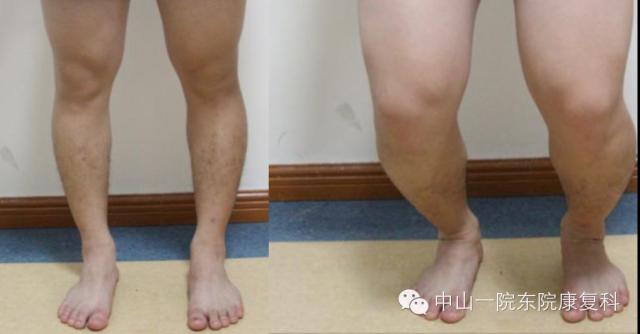 康复治疗技术人体解剖学,12条筋膜链解析及治疗手法