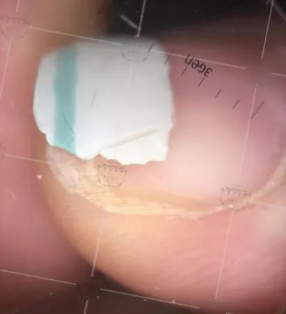 灰指甲美甲处理,灰指甲霉菌感染致癌