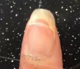 灰指甲美甲处理,灰指甲霉菌感染致癌