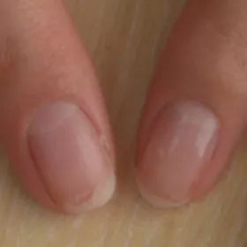 灰指甲美甲处理,灰指甲霉菌感染致癌