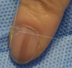 灰指甲美甲处理,灰指甲霉菌感染致癌