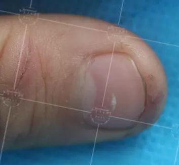 灰指甲美甲处理,灰指甲霉菌感染致癌