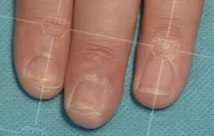 灰指甲美甲处理,灰指甲霉菌感染致癌