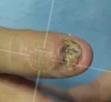 灰指甲美甲处理,灰指甲霉菌感染致癌