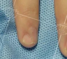 灰指甲美甲处理,灰指甲霉菌感染致癌