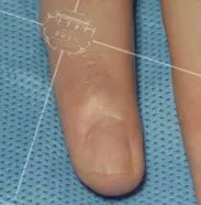 灰指甲美甲处理,灰指甲霉菌感染致癌