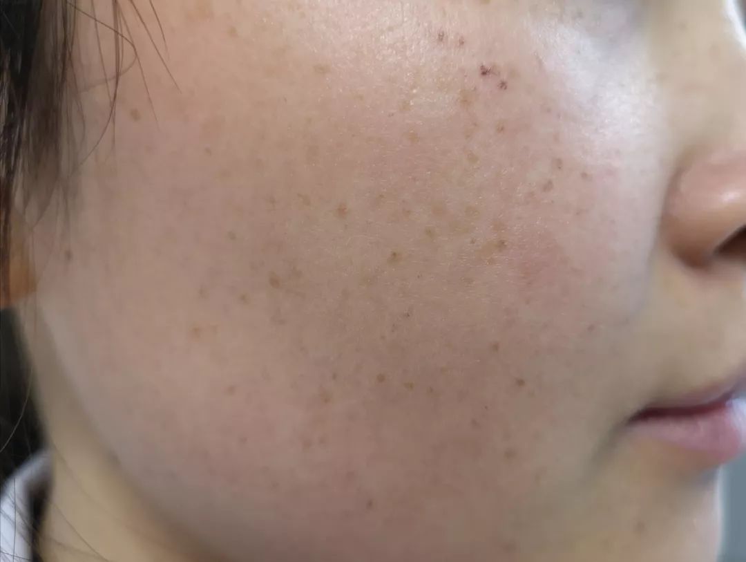 雀斑样痣和雀斑的区别有哪些,雀斑和青褐色痣