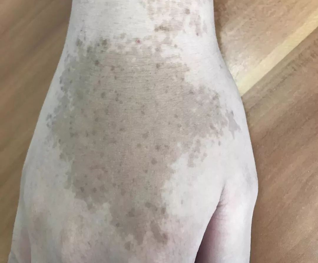 雀斑样痣和雀斑的区别有哪些,雀斑和青褐色痣