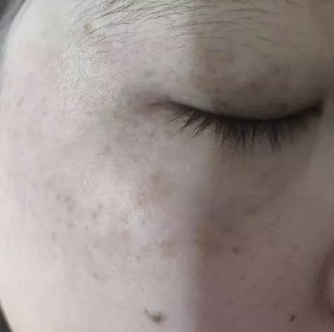 雀斑样痣和雀斑的区别有哪些,雀斑和青褐色痣