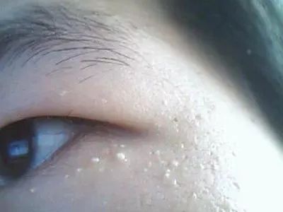 脂肪粒的由来,杏林微科普帮您认识各类头晕